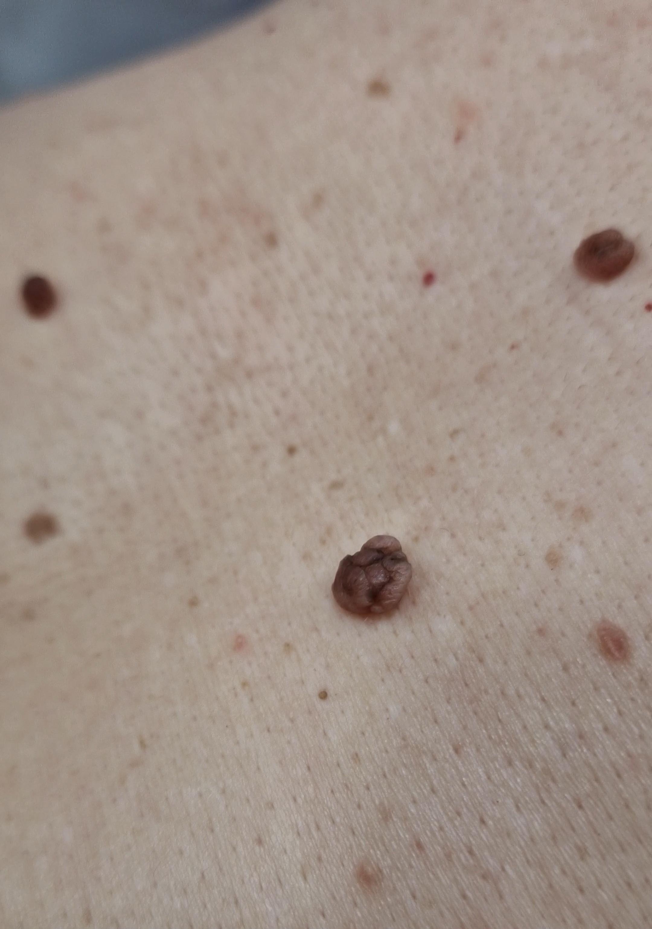 Удаление родинок в Черкесске у онколога в клинике доктора Байкуловой