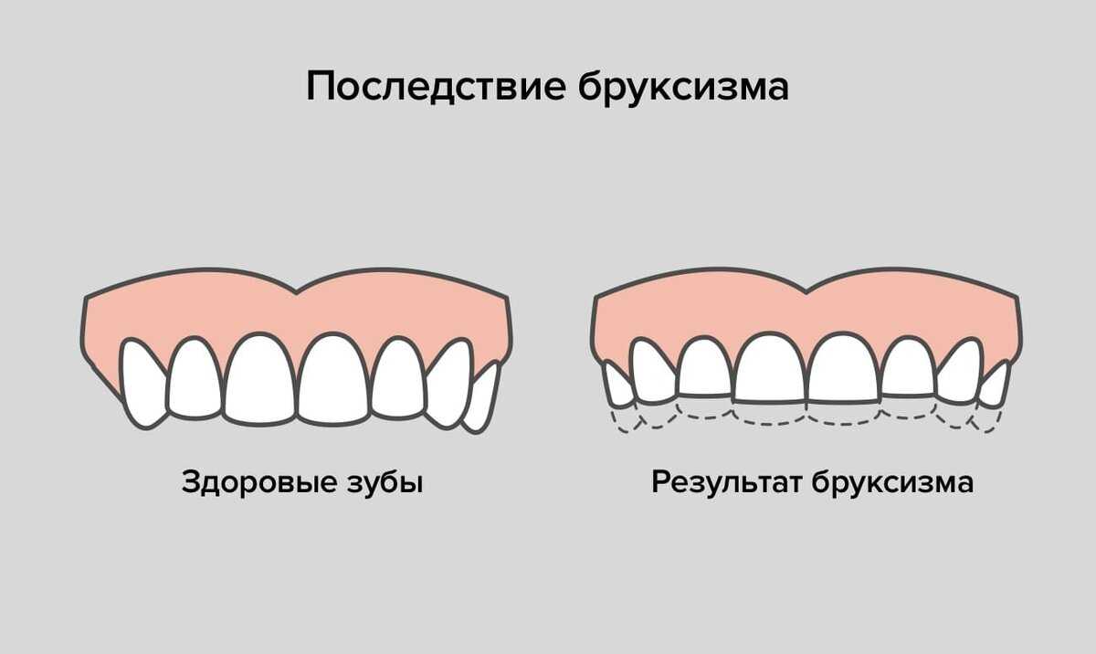 Бруксизм. Скрежет зубами