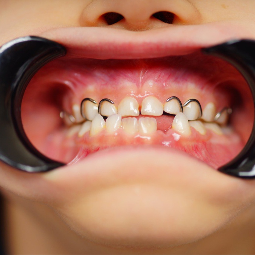 Лечение зубов