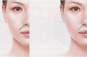 Техника введения филлеров