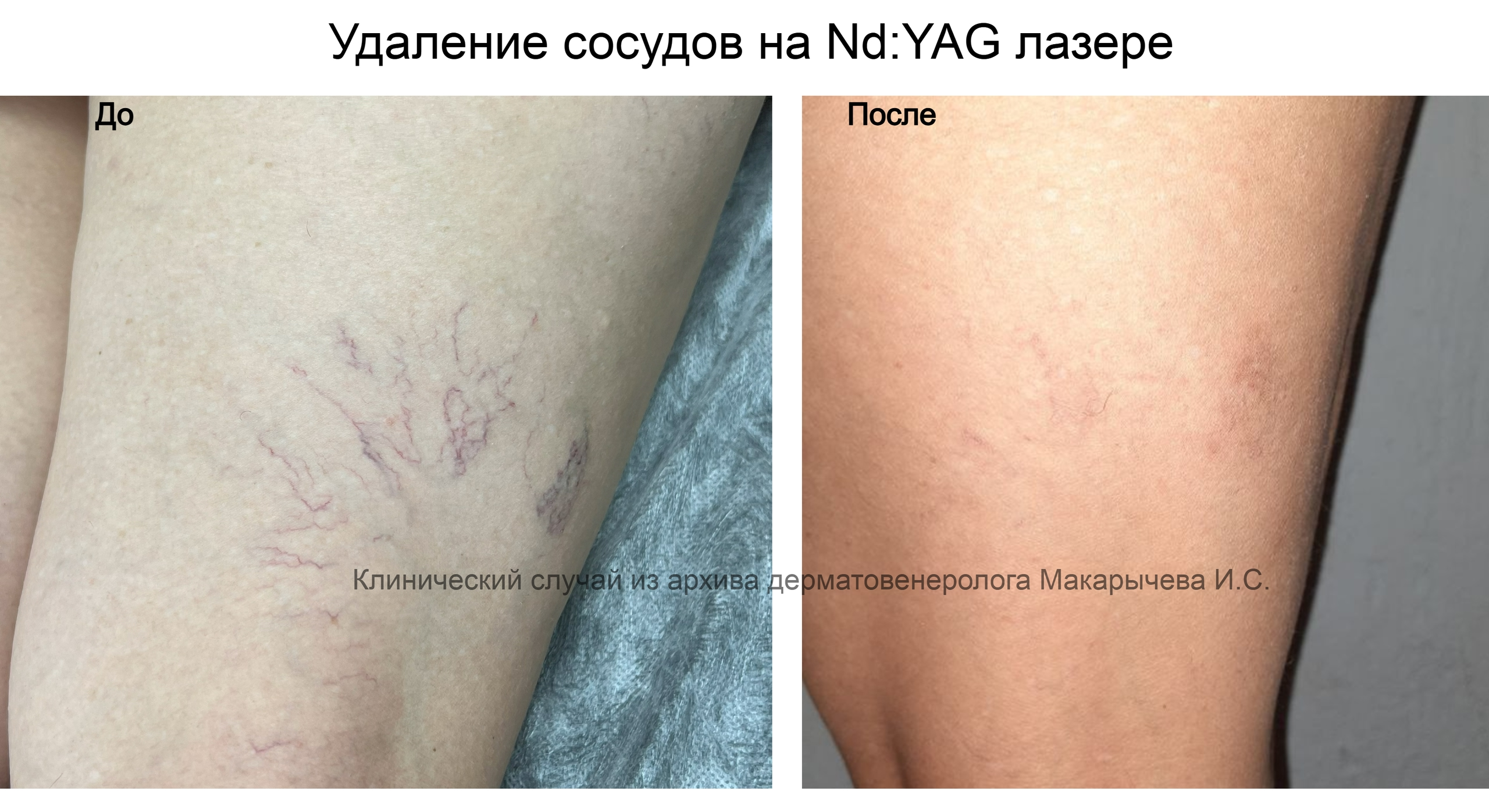 лечение кондилом