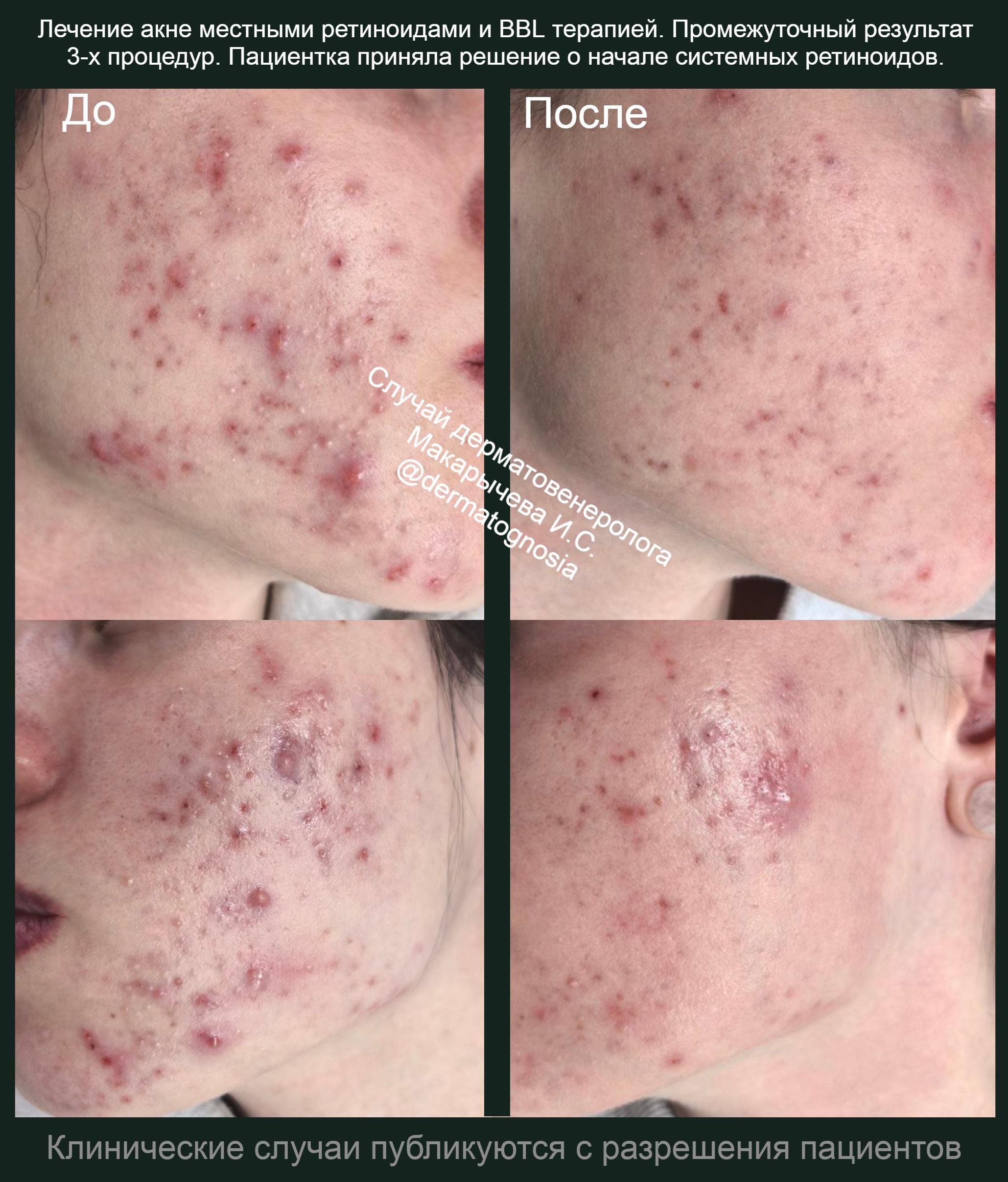 лечение кондилом