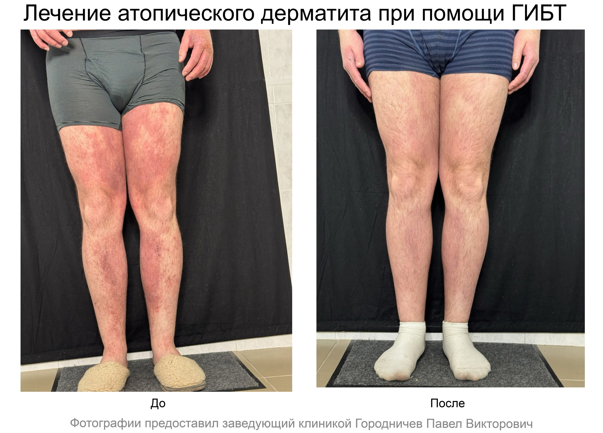 лечение кондилом