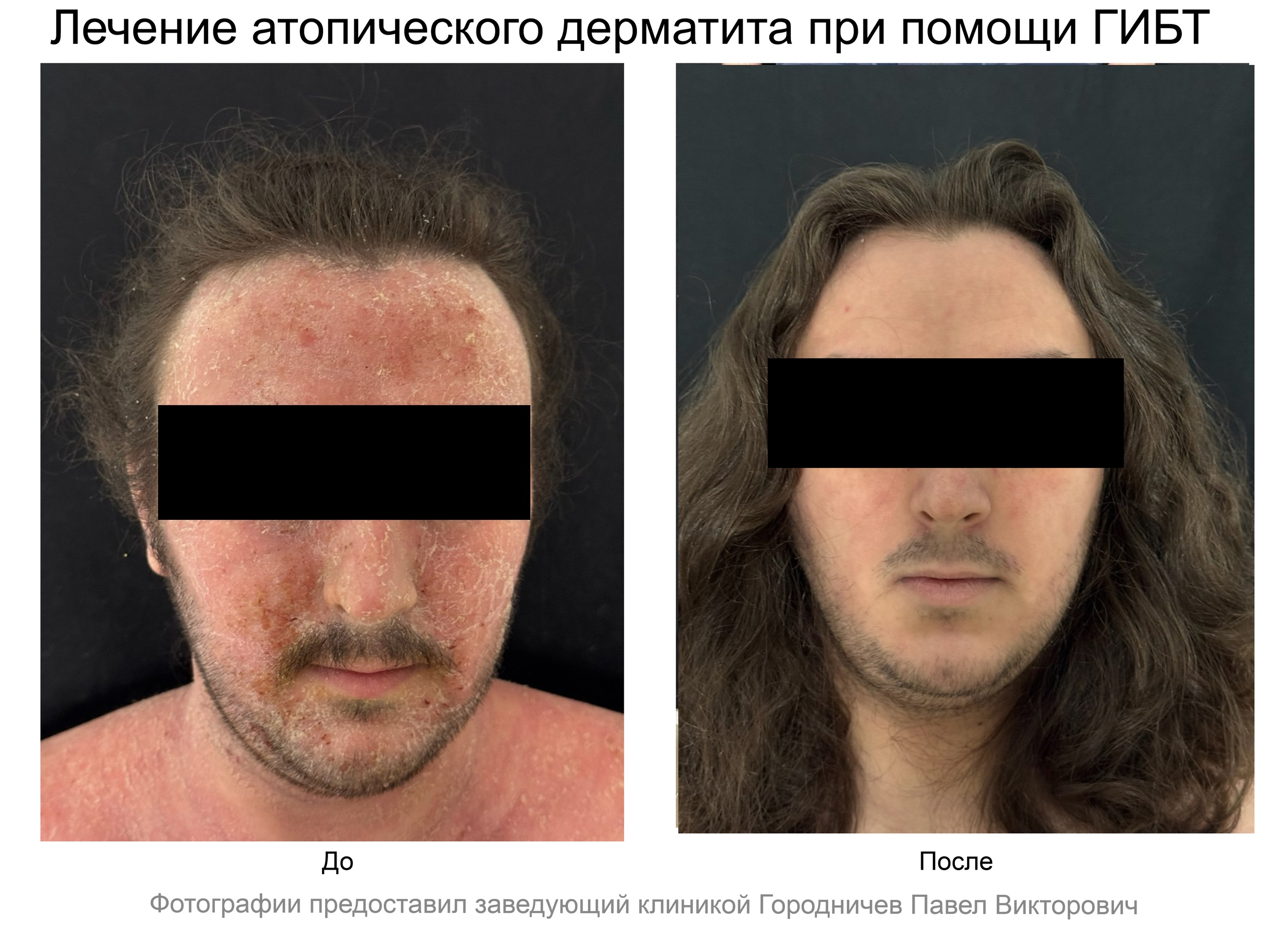 лечение кондилом