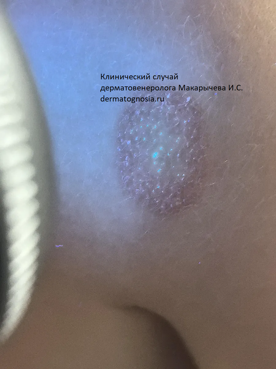 Свечение лишая под Лампой Вуда