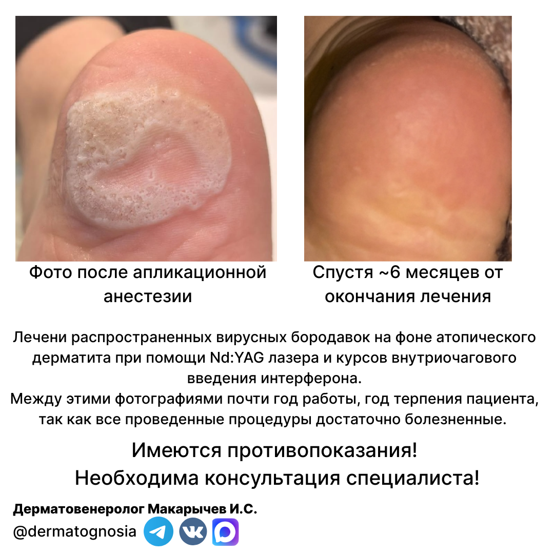 Лазерное лечение вирусных бородавок