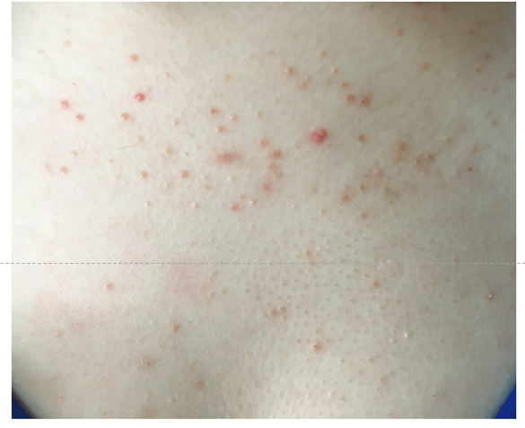 аллергия на мефедрон фото