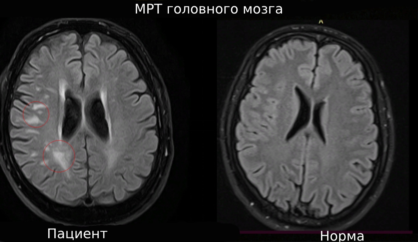 нейросифилис мрт