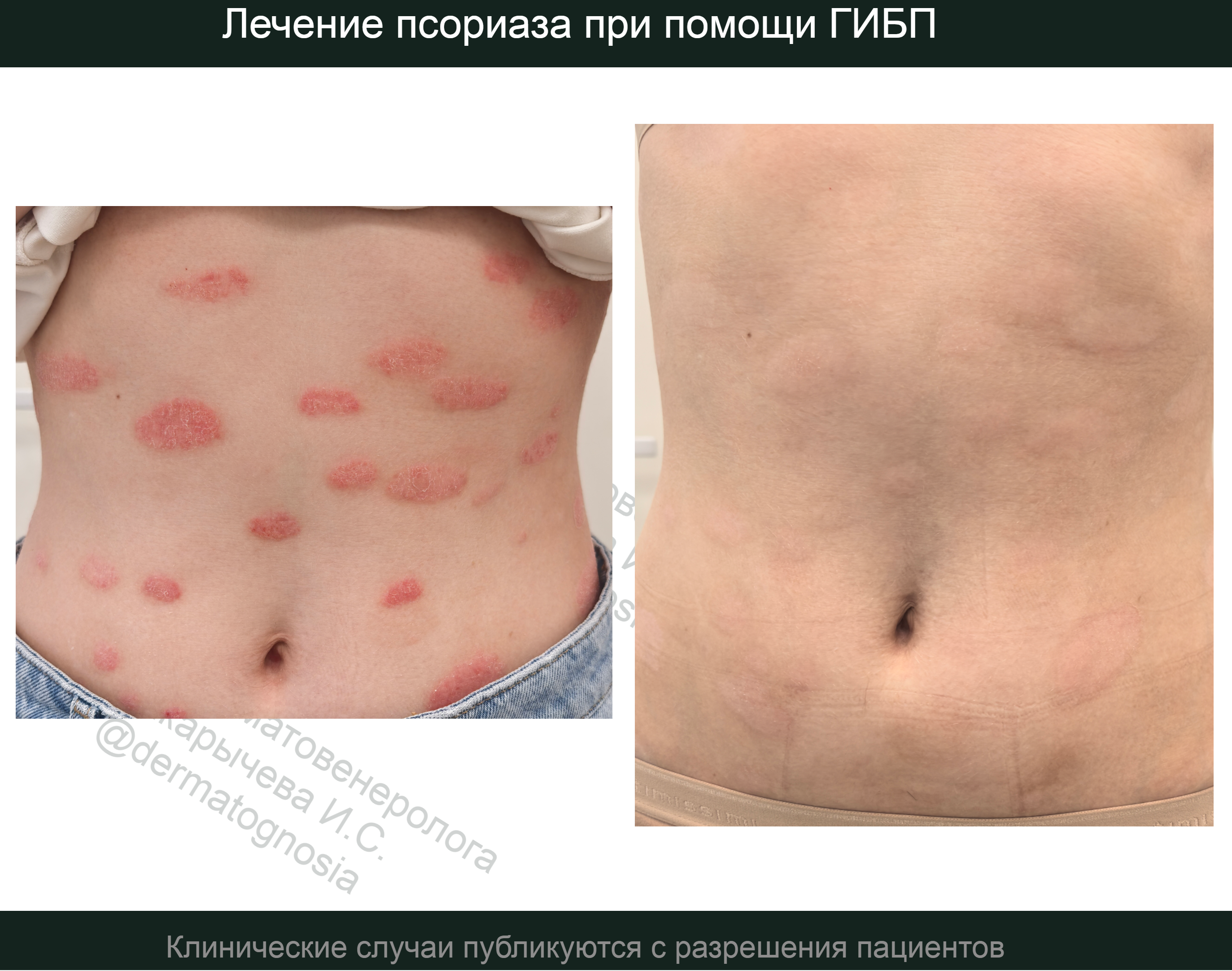Лечение псориаза эфлейров в Нижнем Новгороде