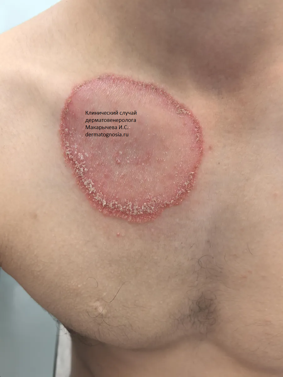 Большой кольцевидный очаг поражения кожи грибами - лишай