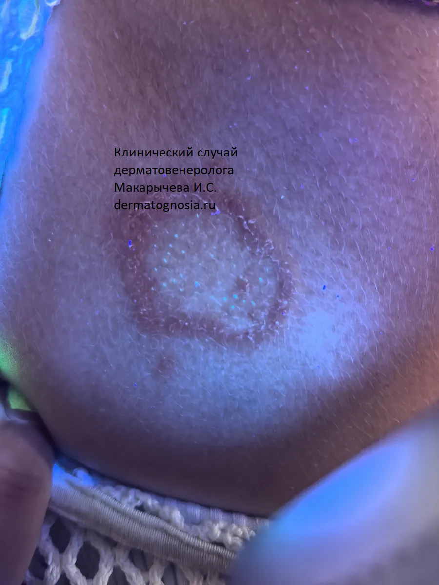 Свечение лишая в ультрафиолете