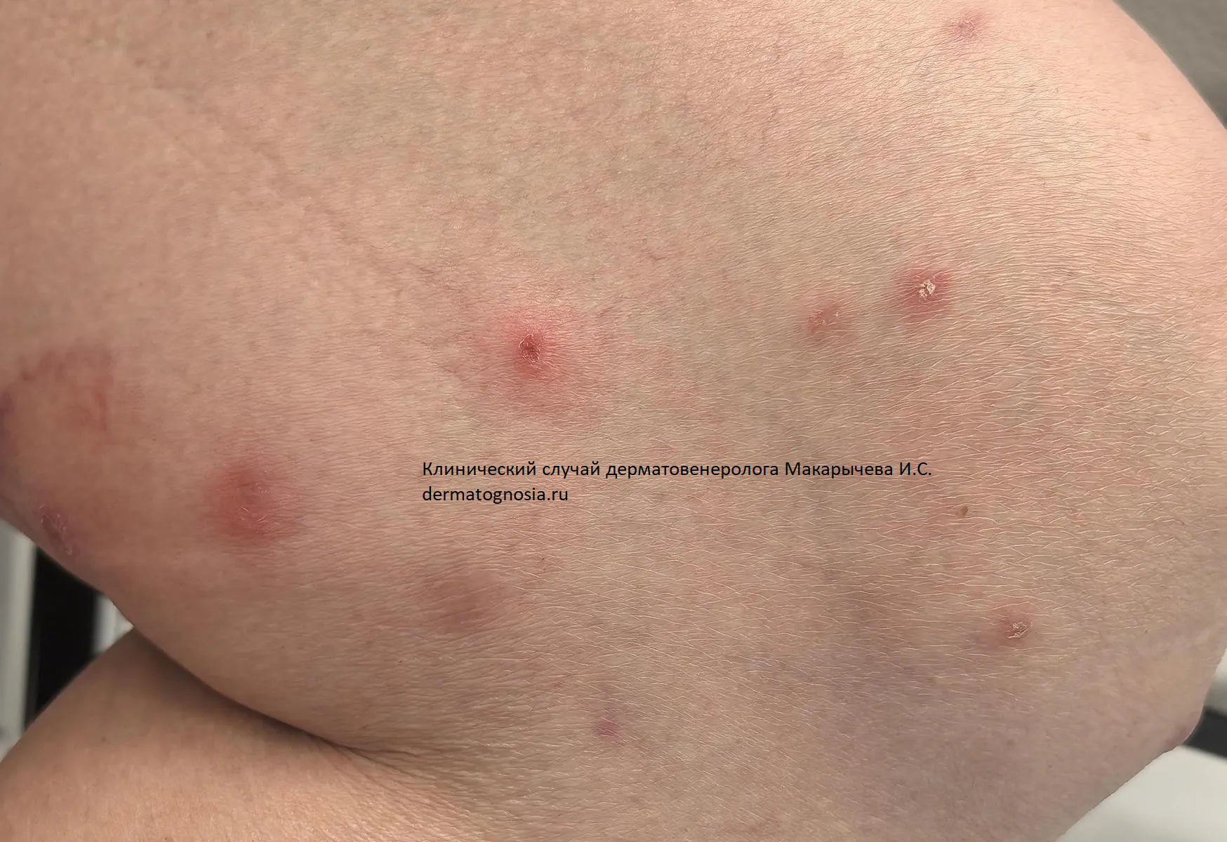 Распространенный лишай кожи