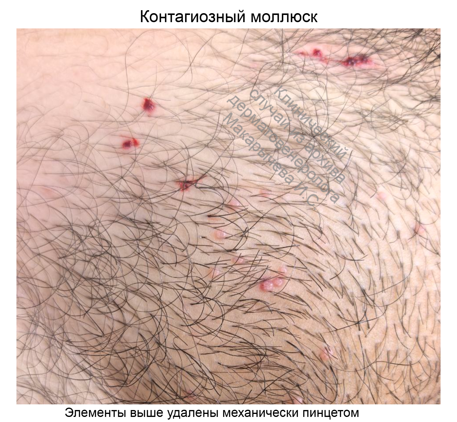 лечение кондилом