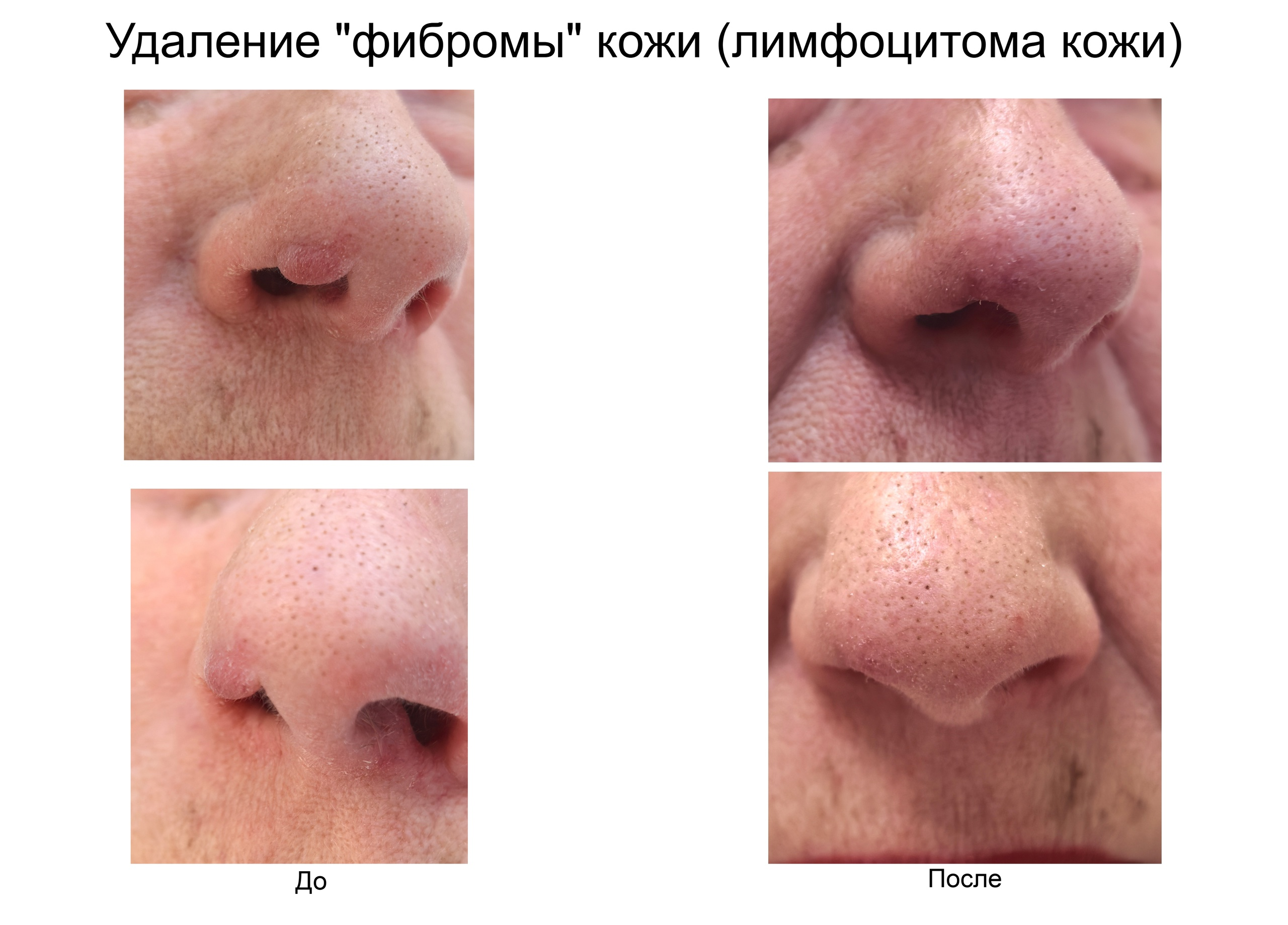 удаление папилом лазером
