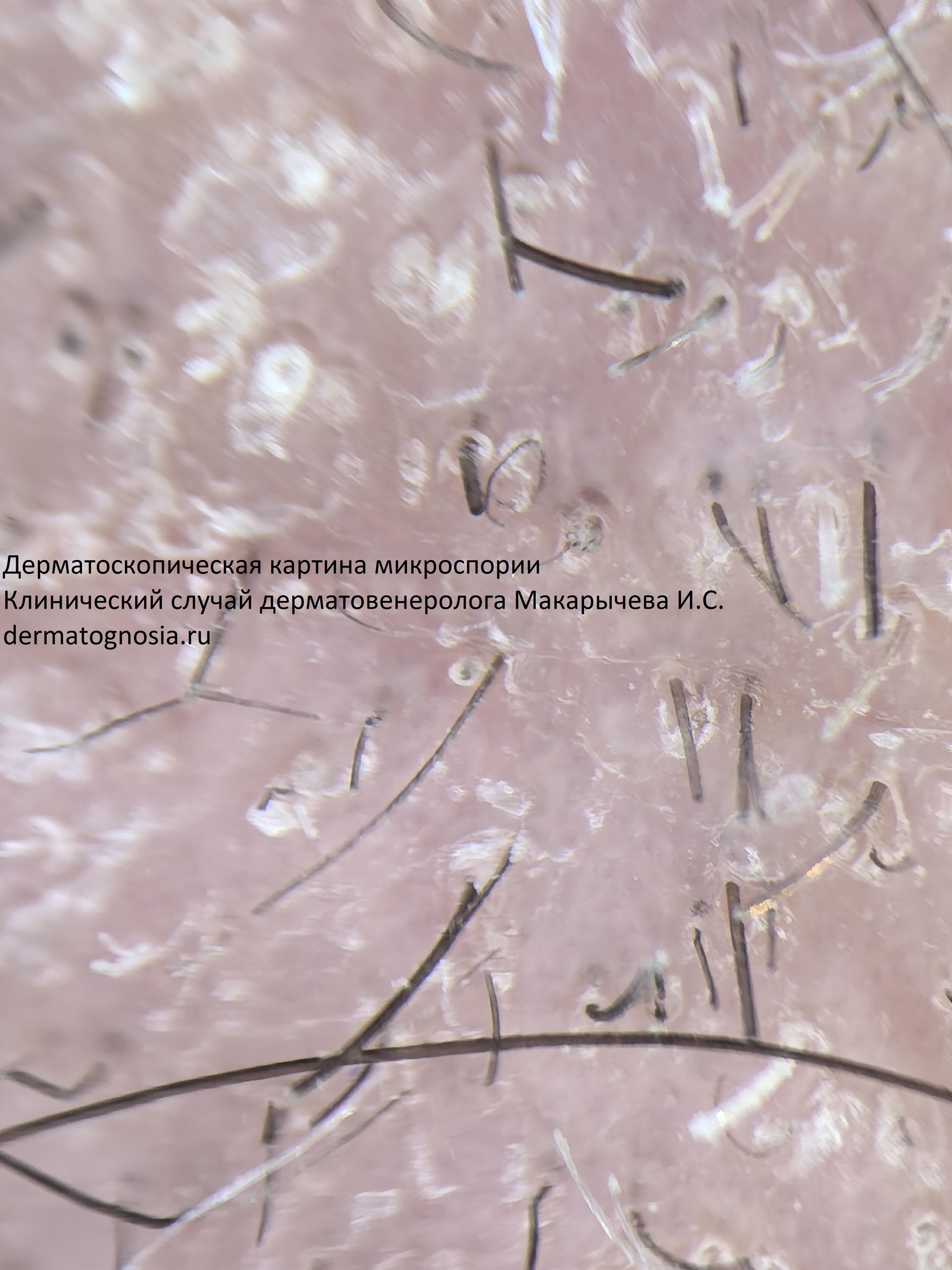 Лишай головы дерматоскопия