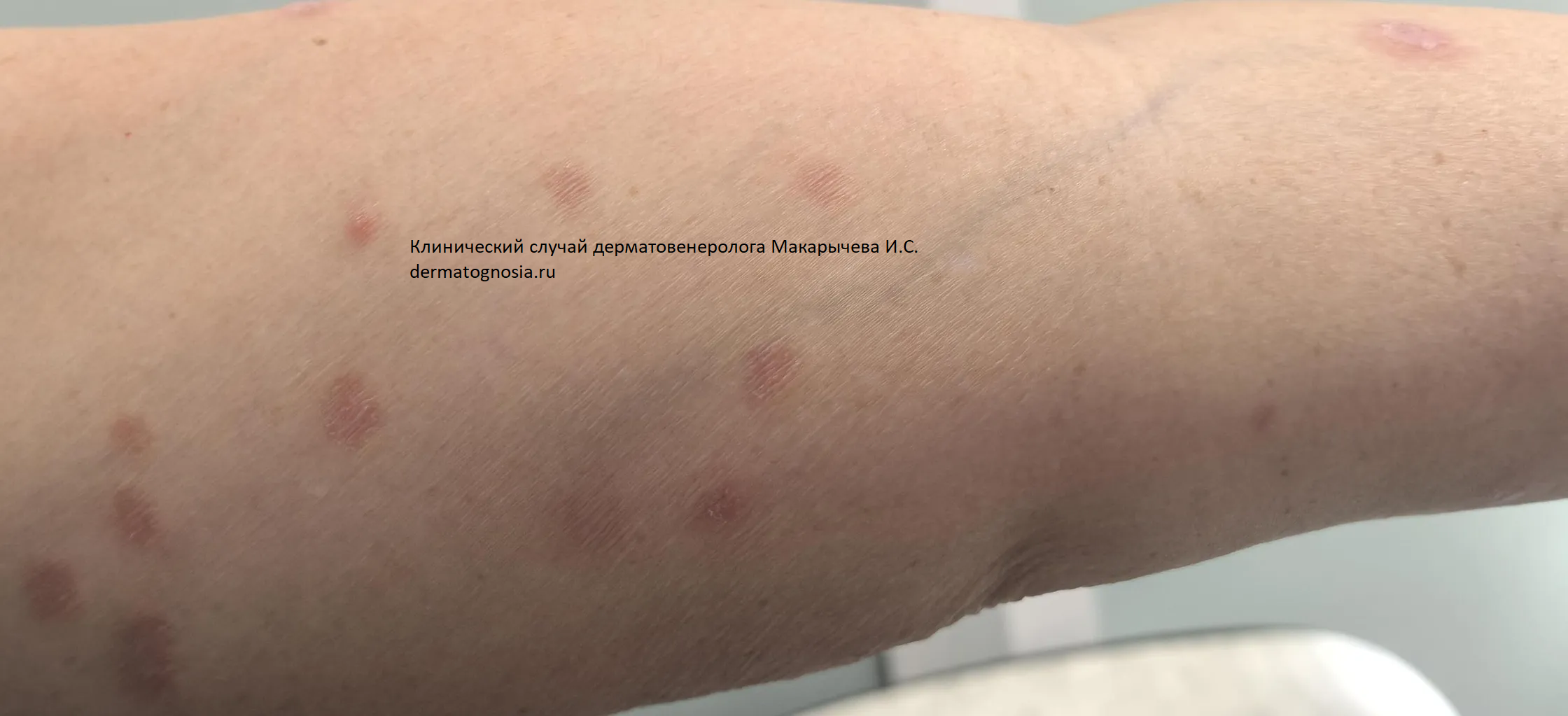 Множественные очаги грибов на кожи предплечья