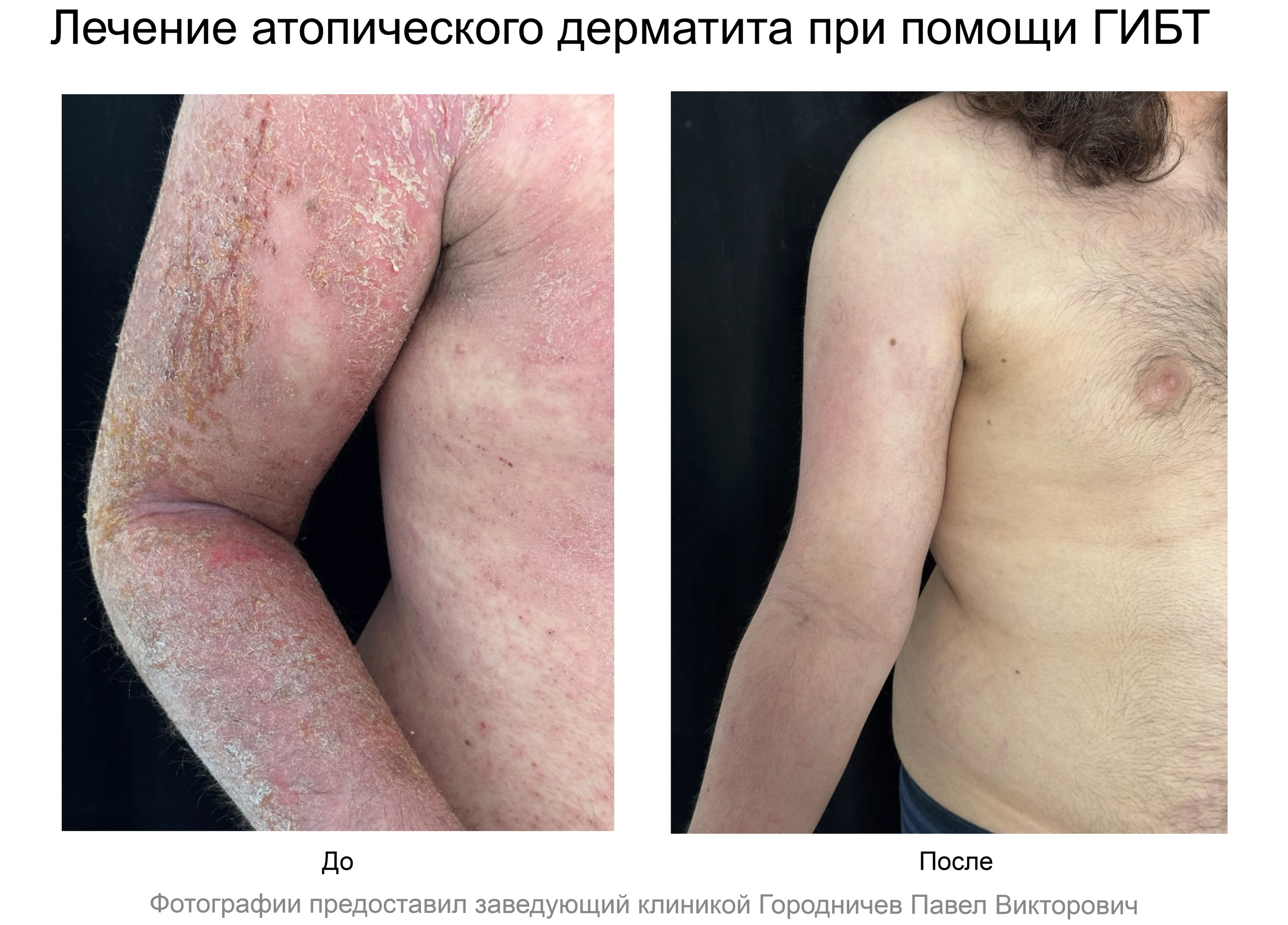 лечение кондилом