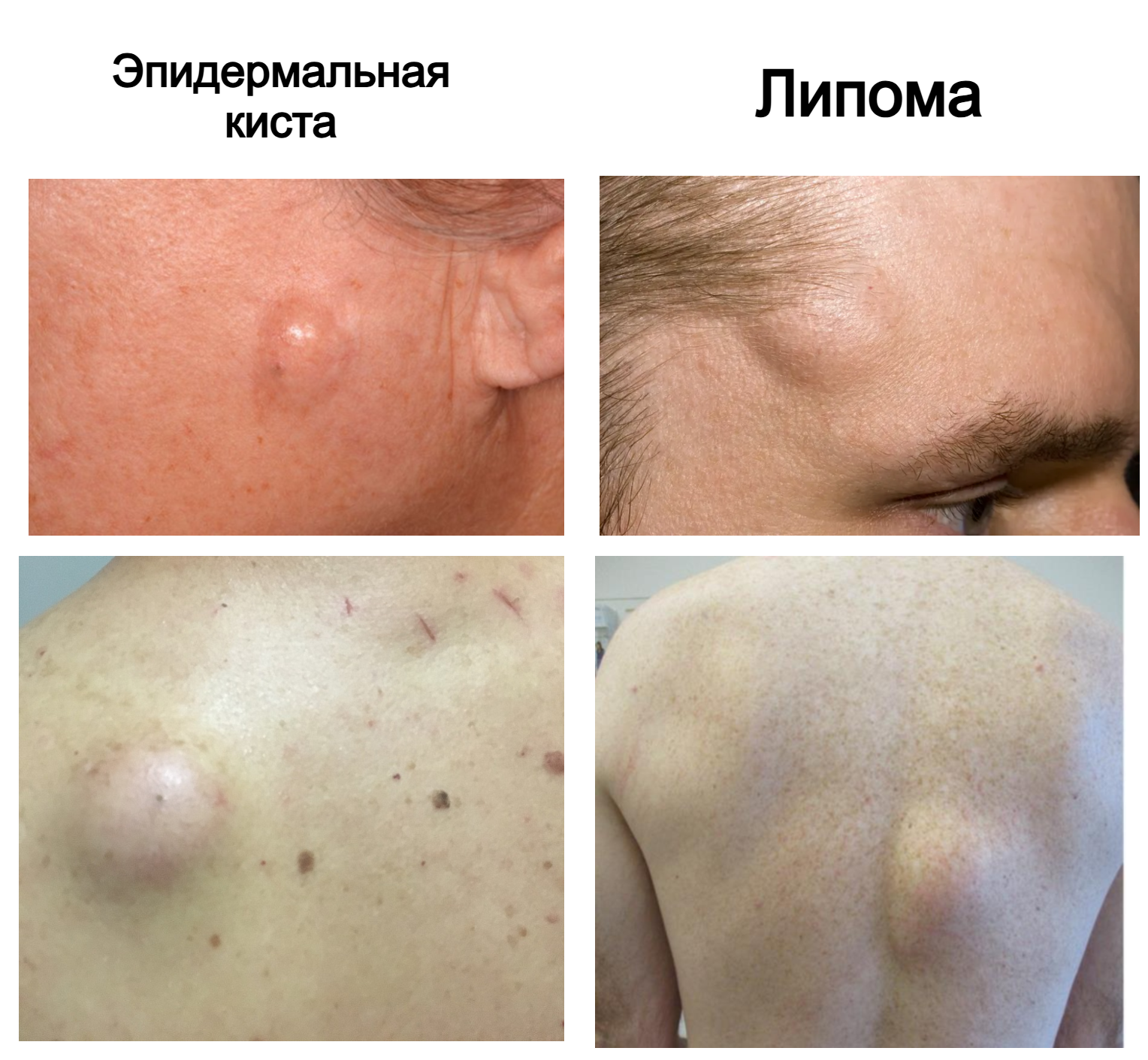 бородавка