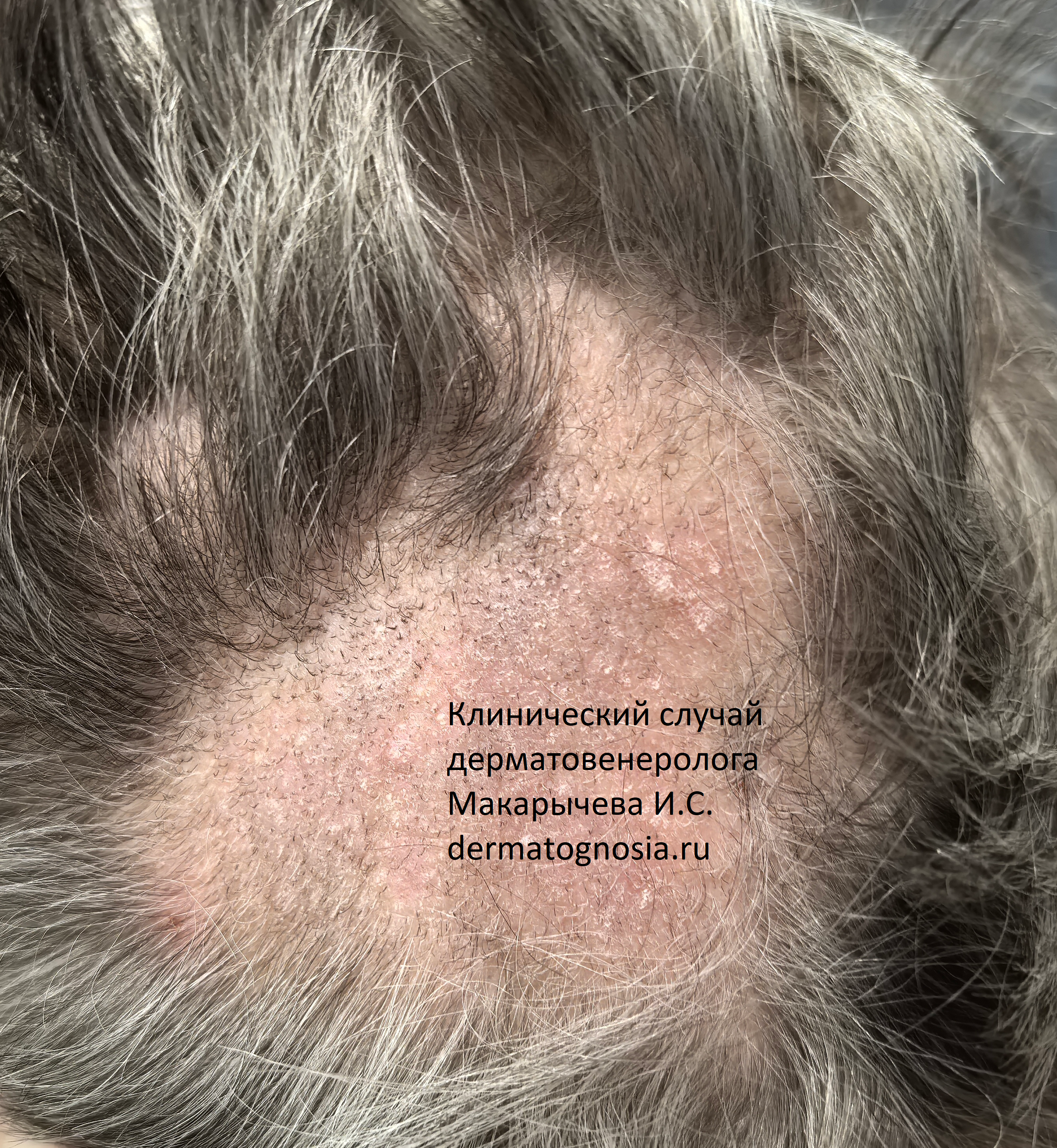 Лишай головы 