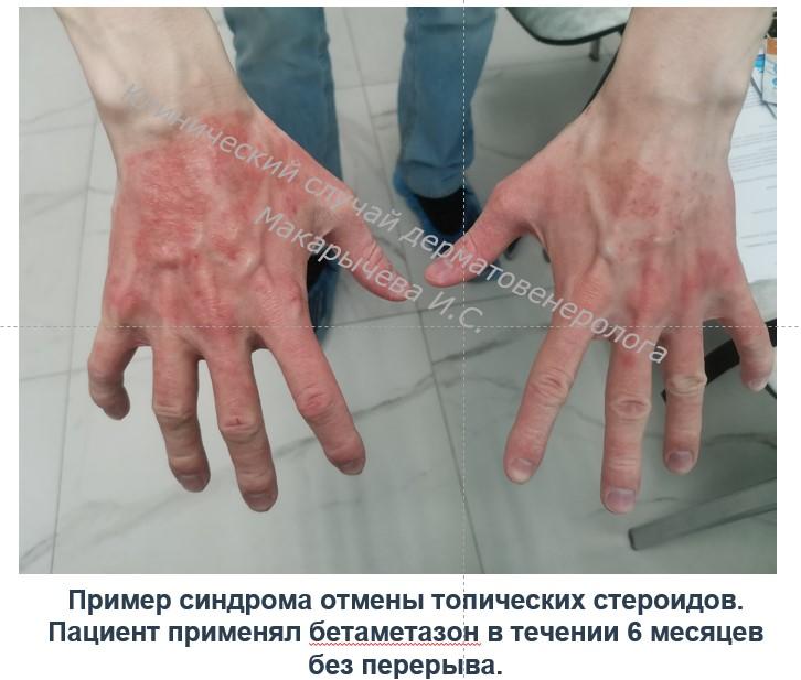 синдром отмены гормональных кремов