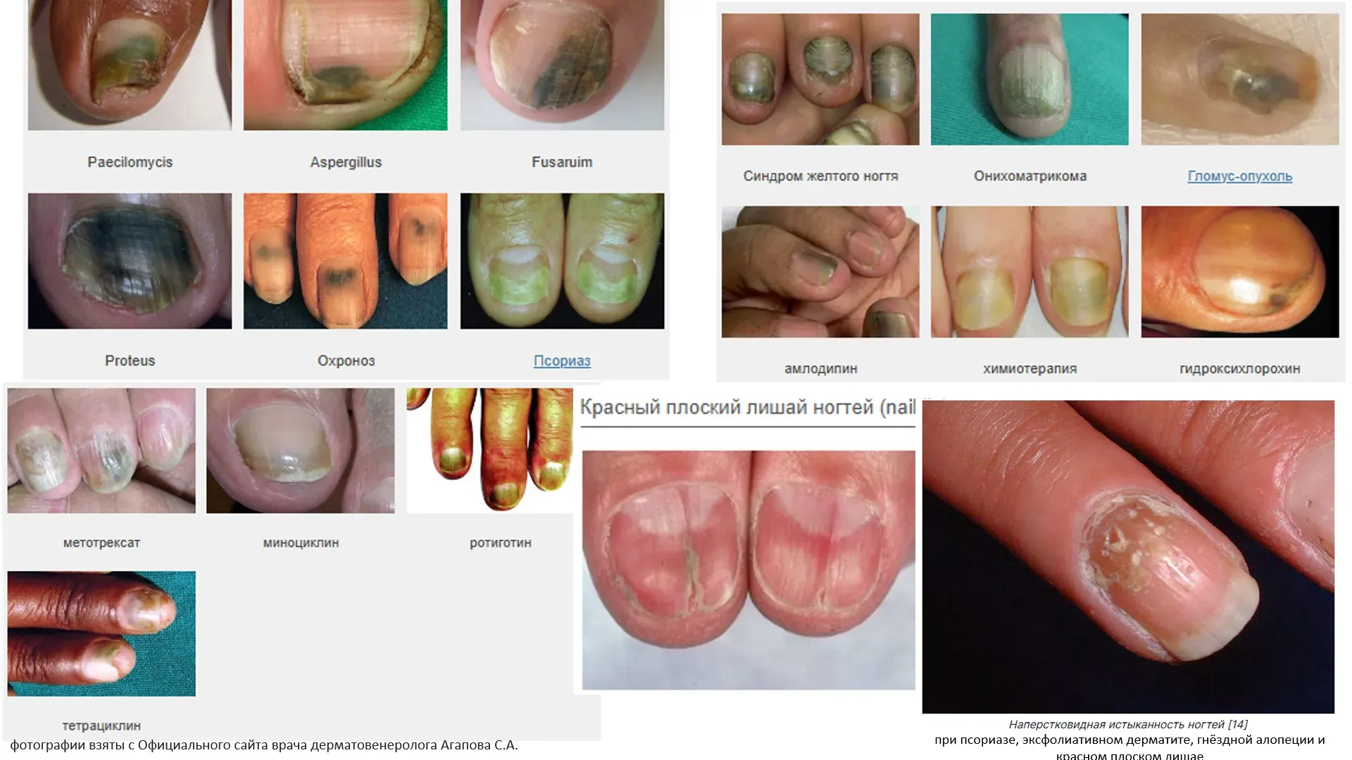 различные причины изменения ногтей