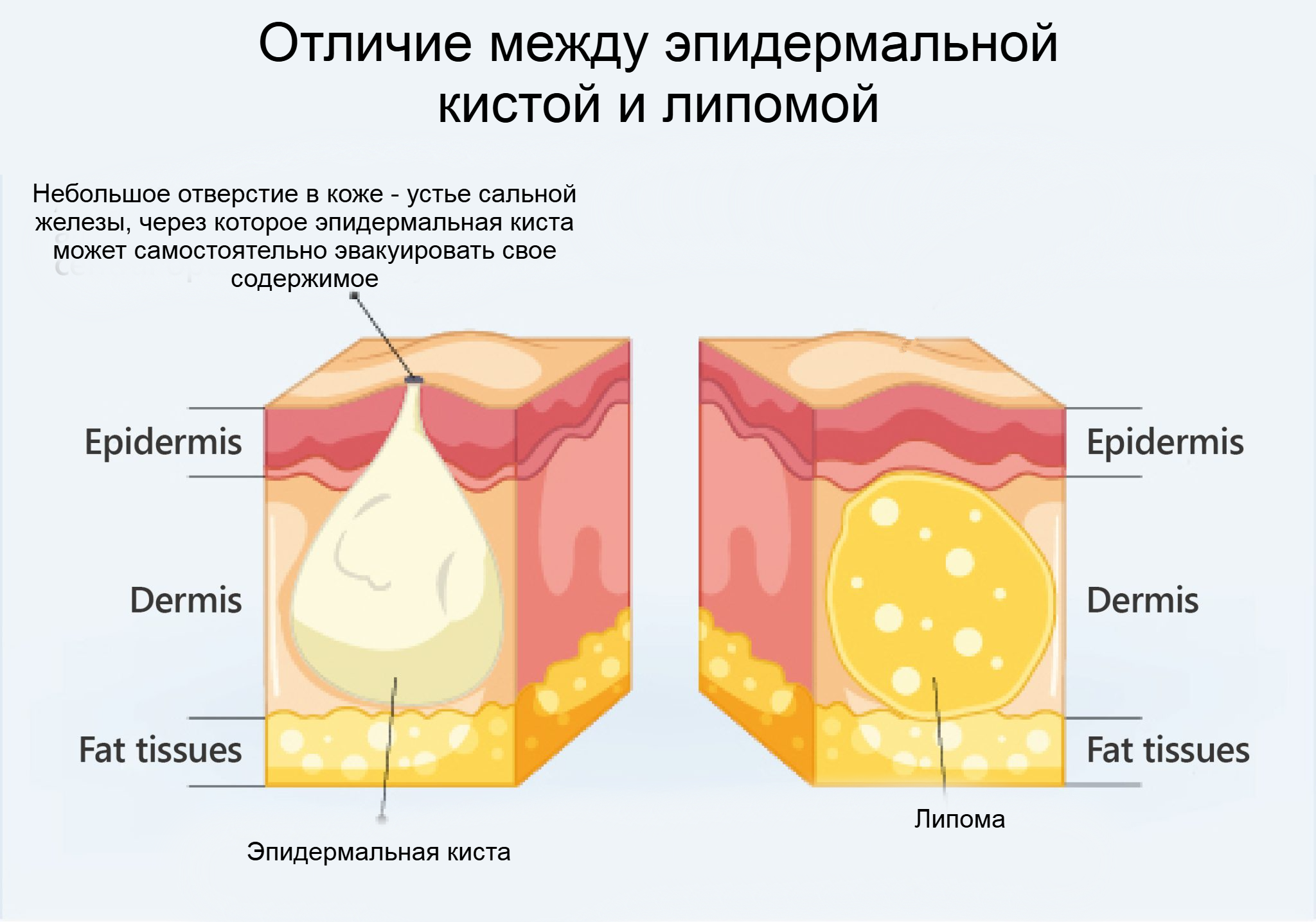 бородавка