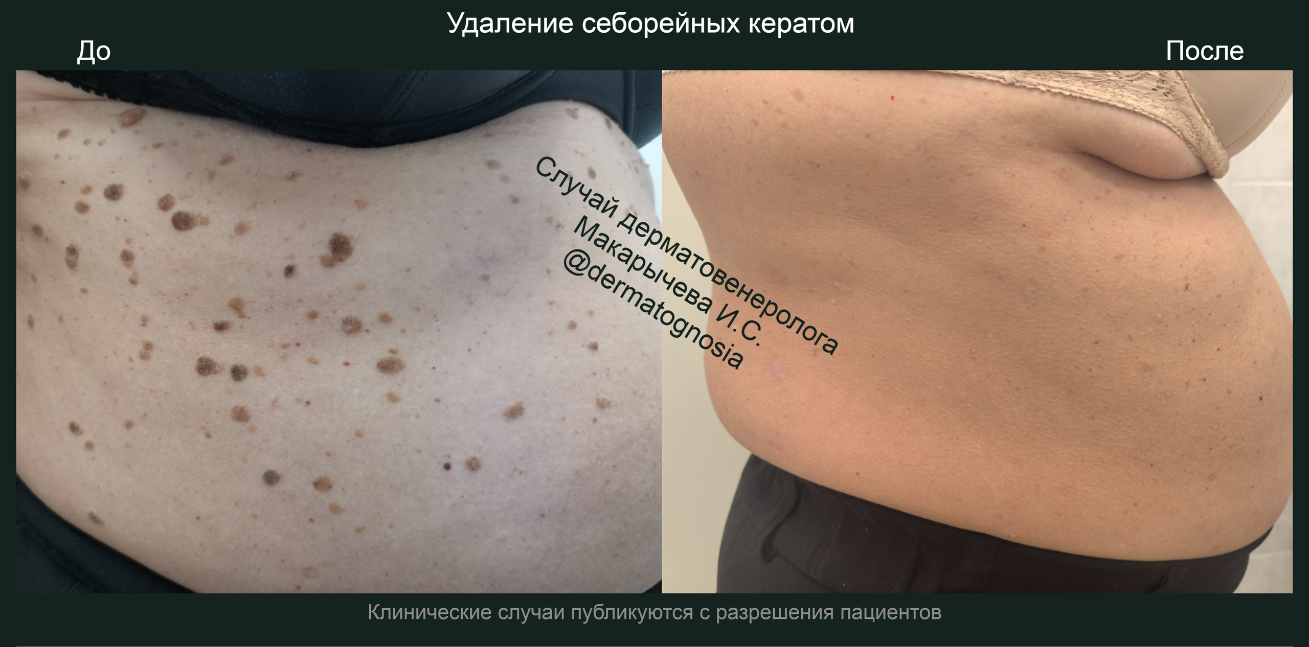 лечение кондилом