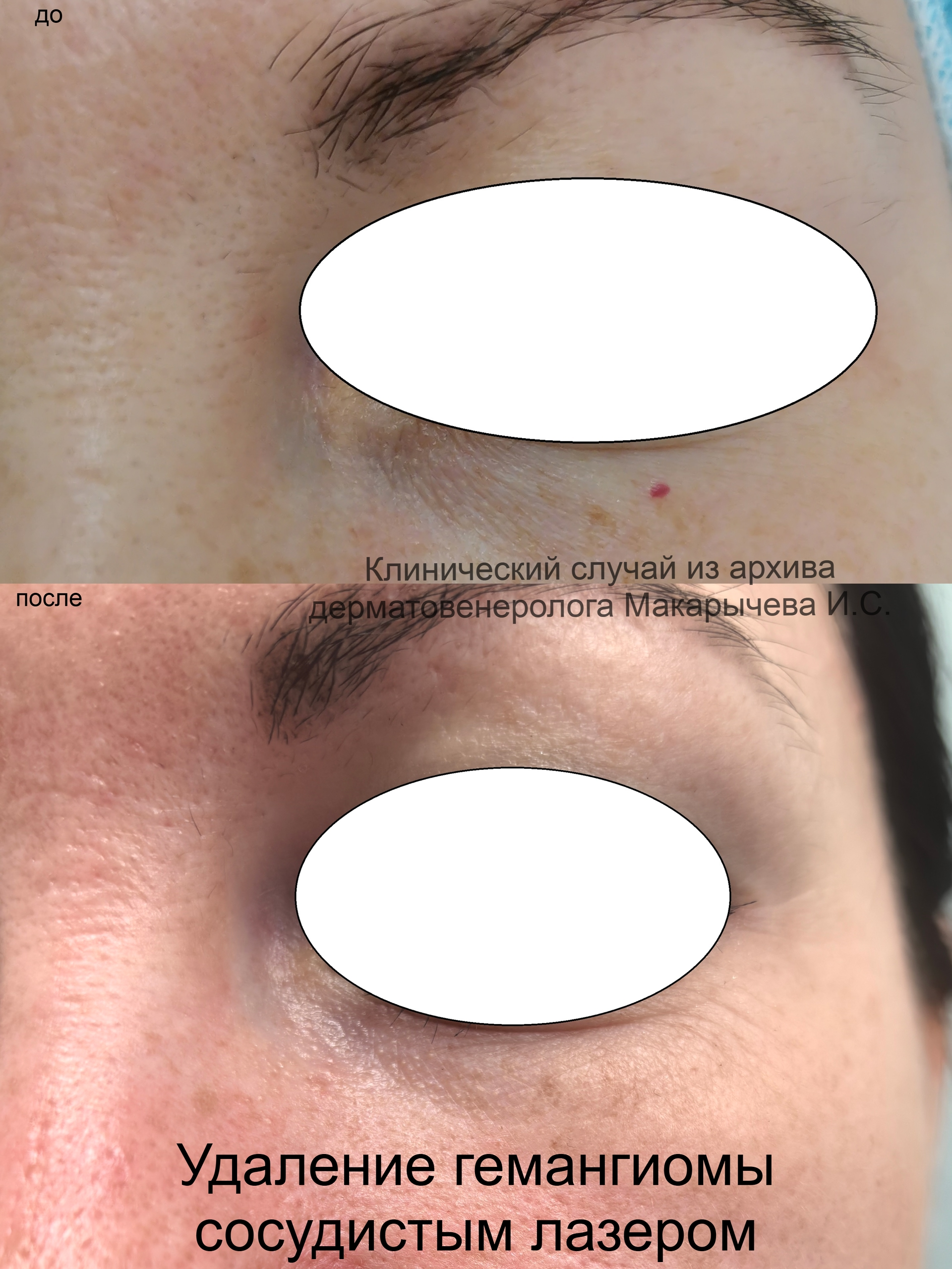 лечение кондилом