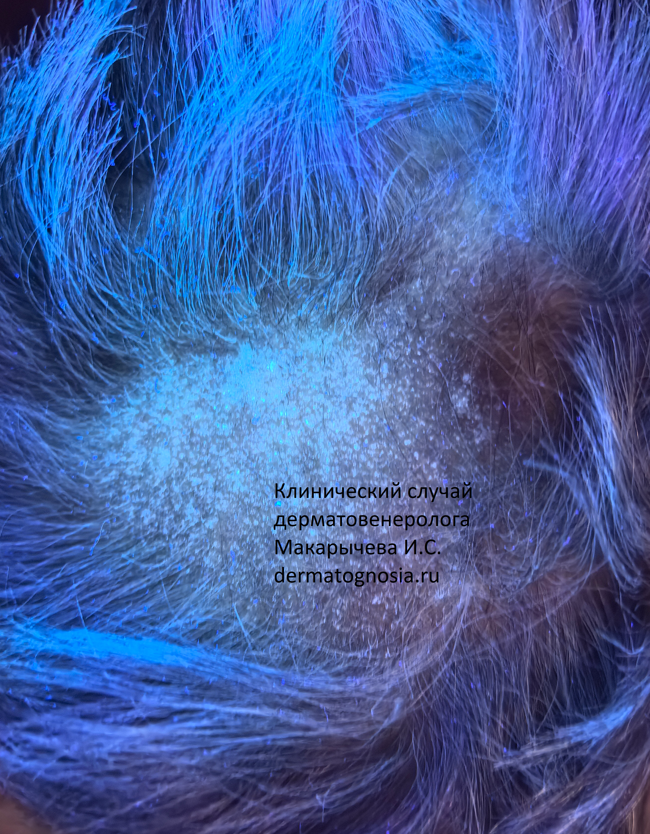 Лишай волос