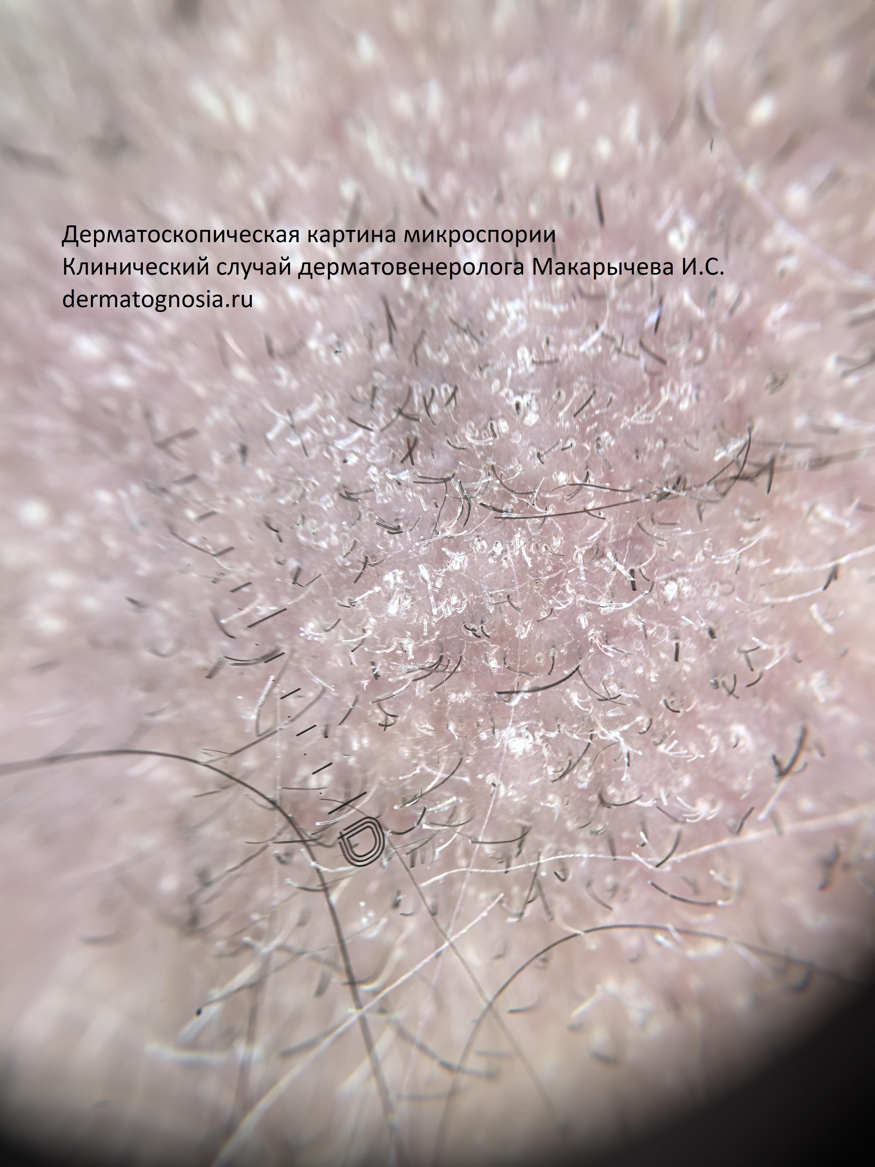 Лишай головы дерматоскопия