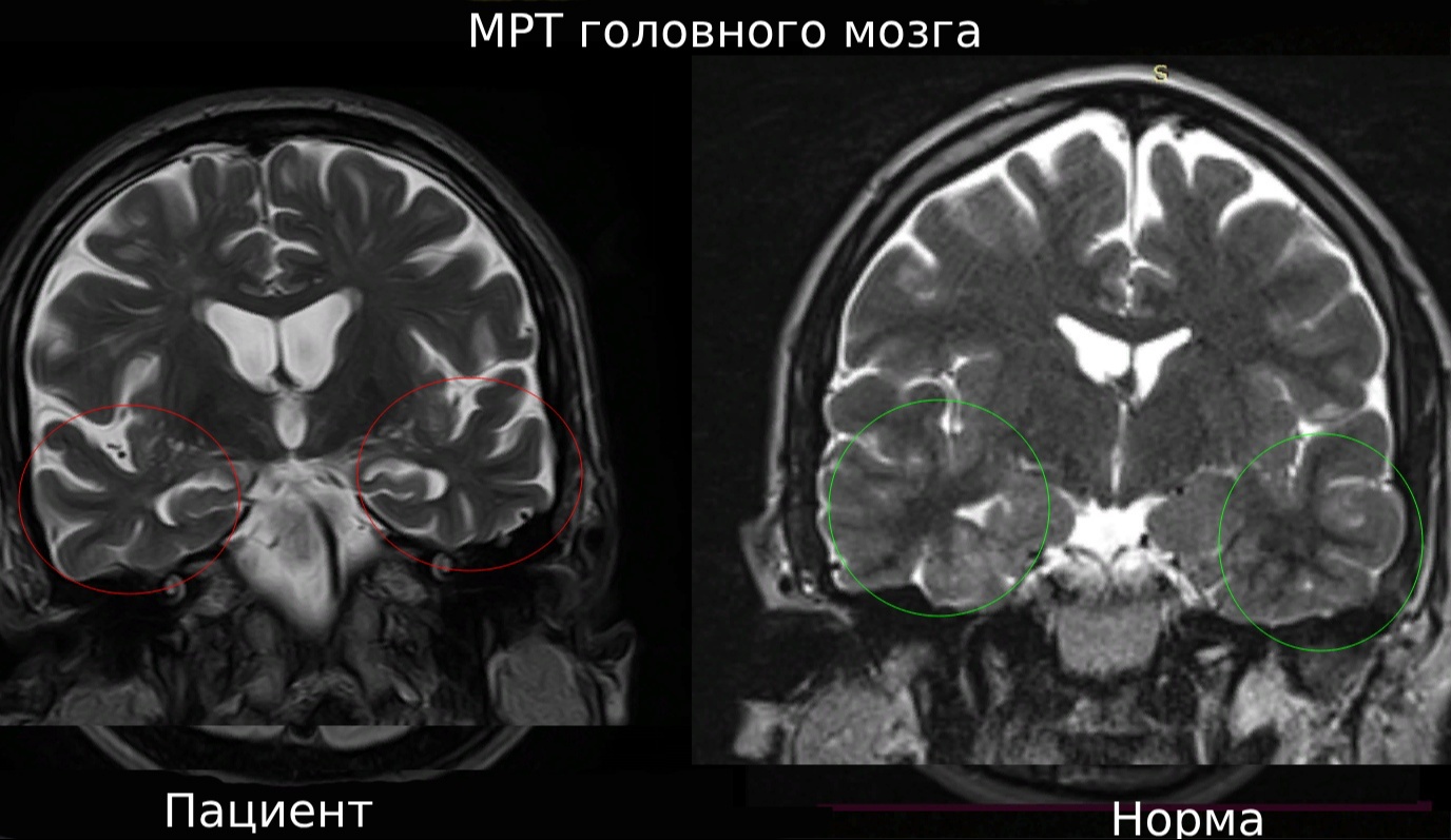 нейросифилис мрт