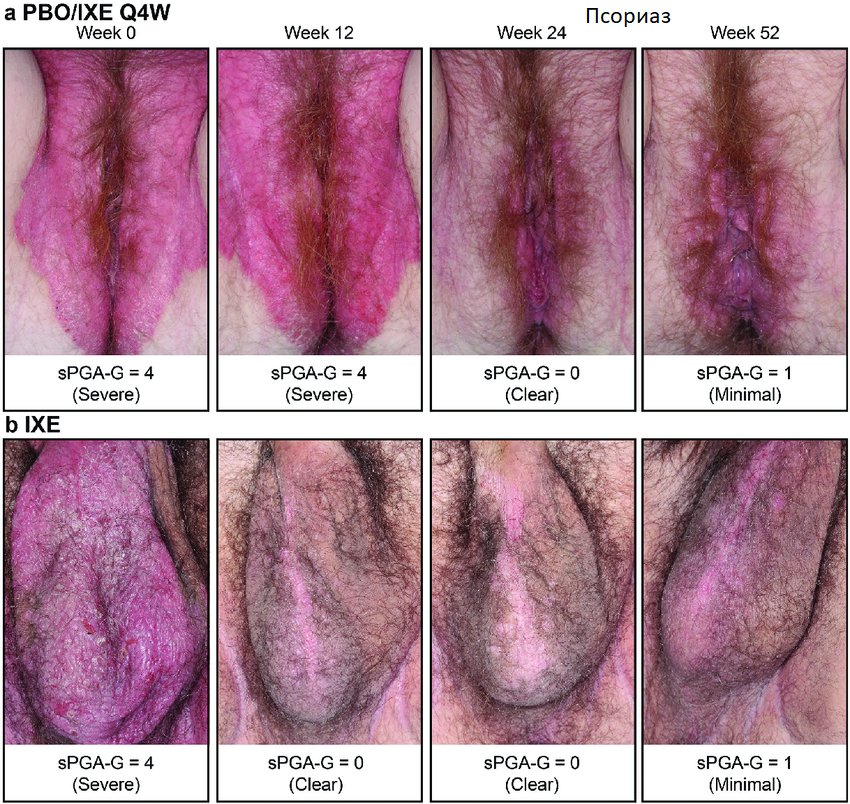 псориаз аногенитальной области