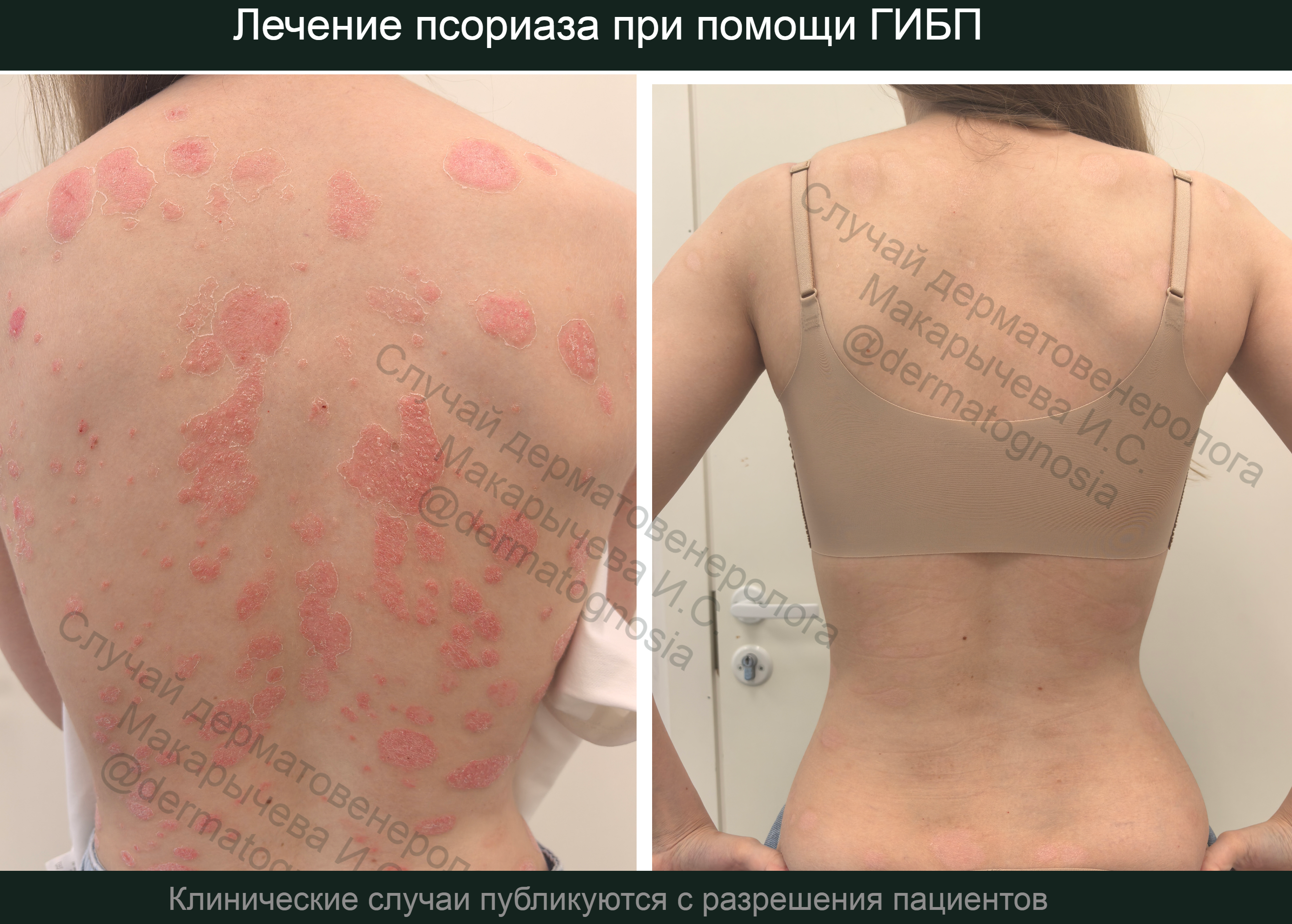 Лечение псориаза эфлейров в Нижнем Новгороде