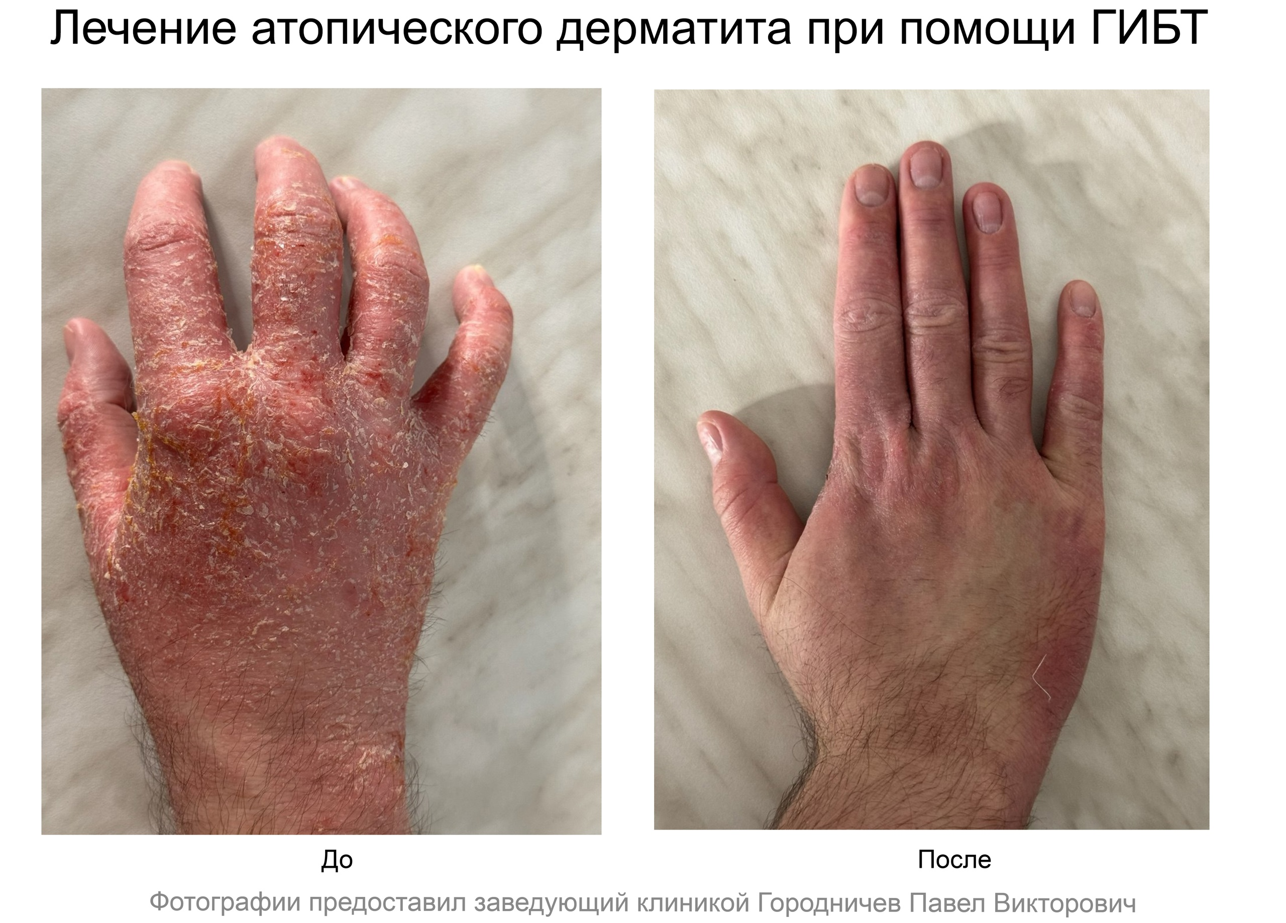 лечение кондилом