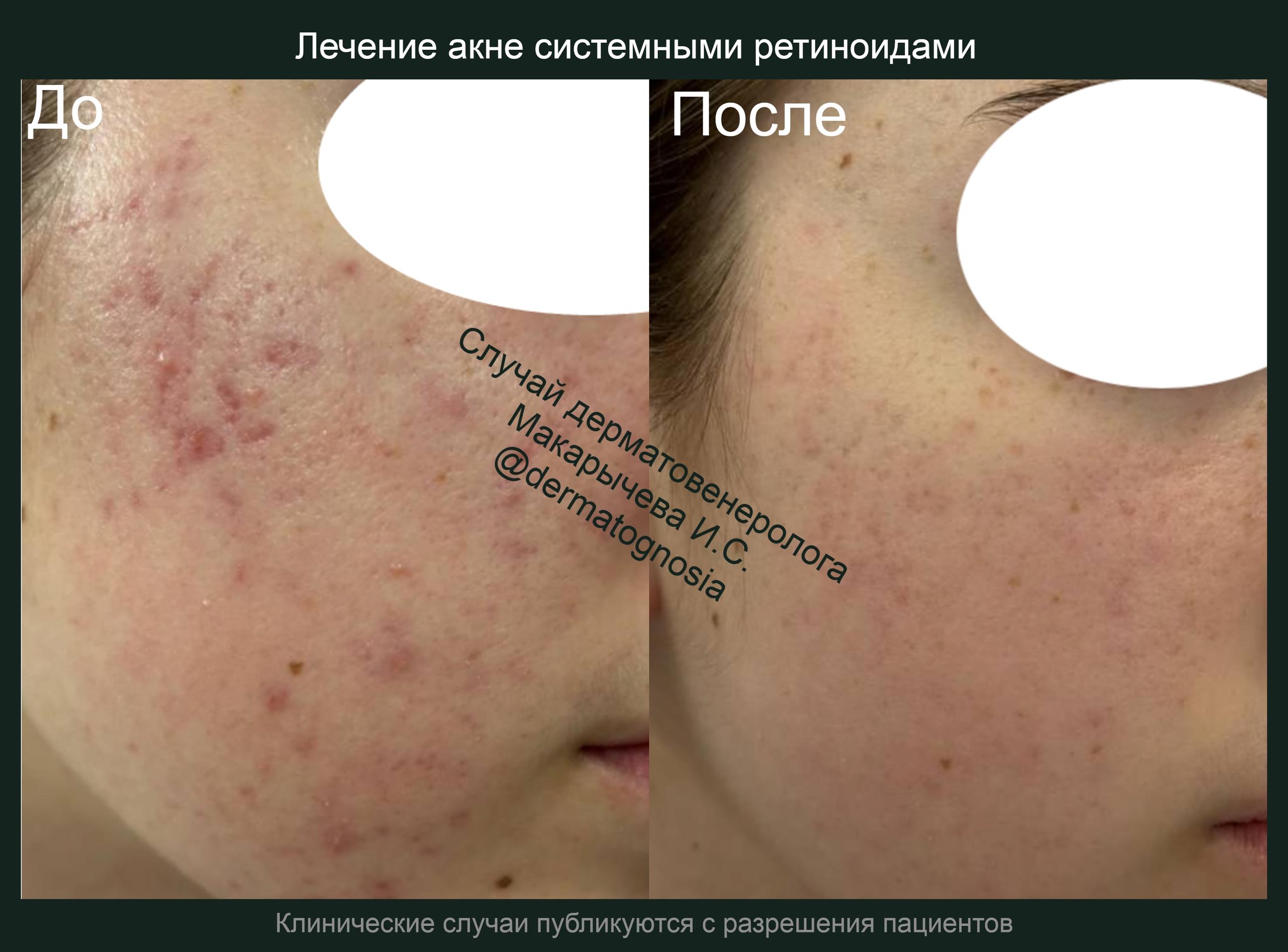 лечение кондилом