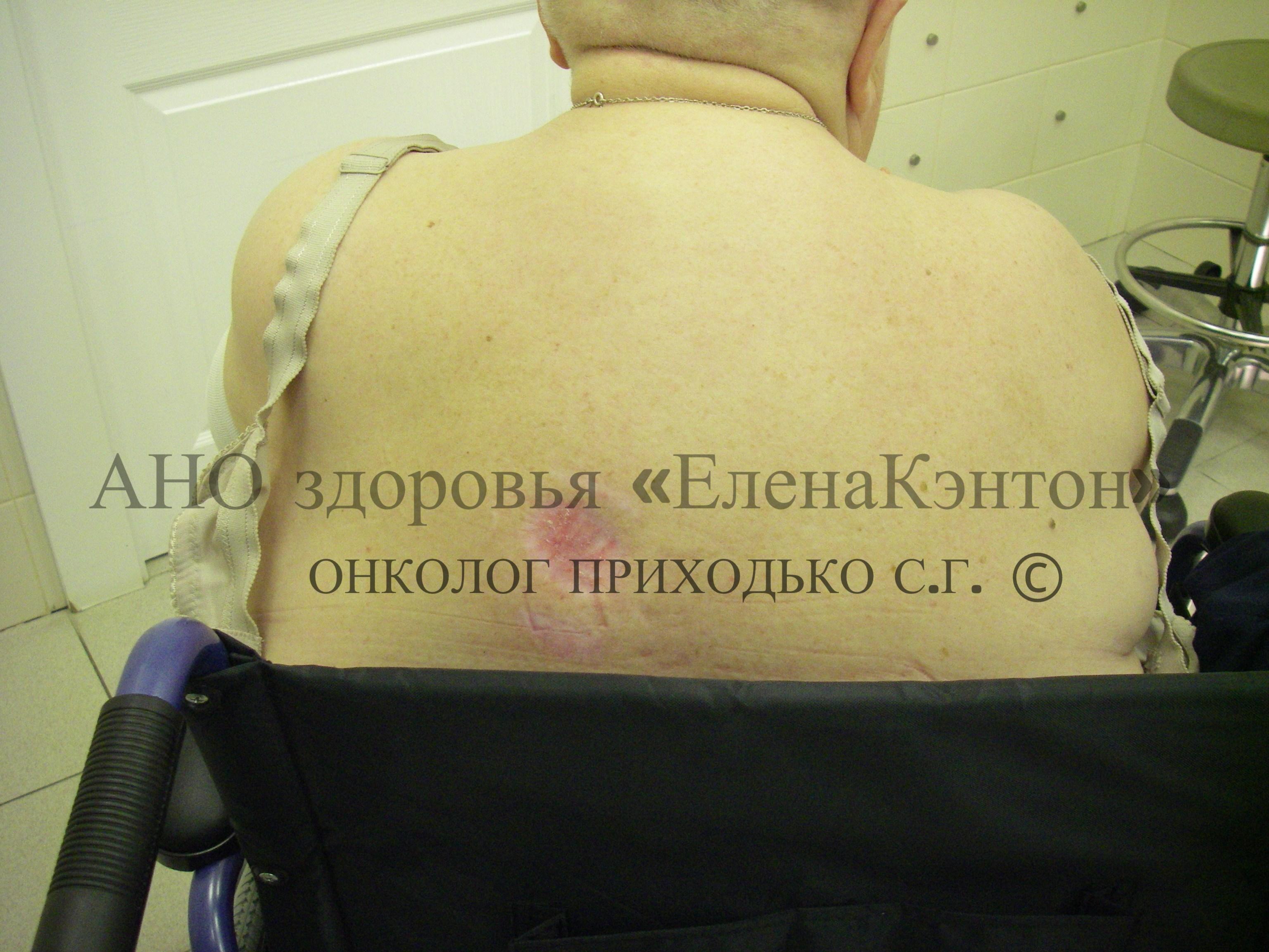 Базалиома на лице