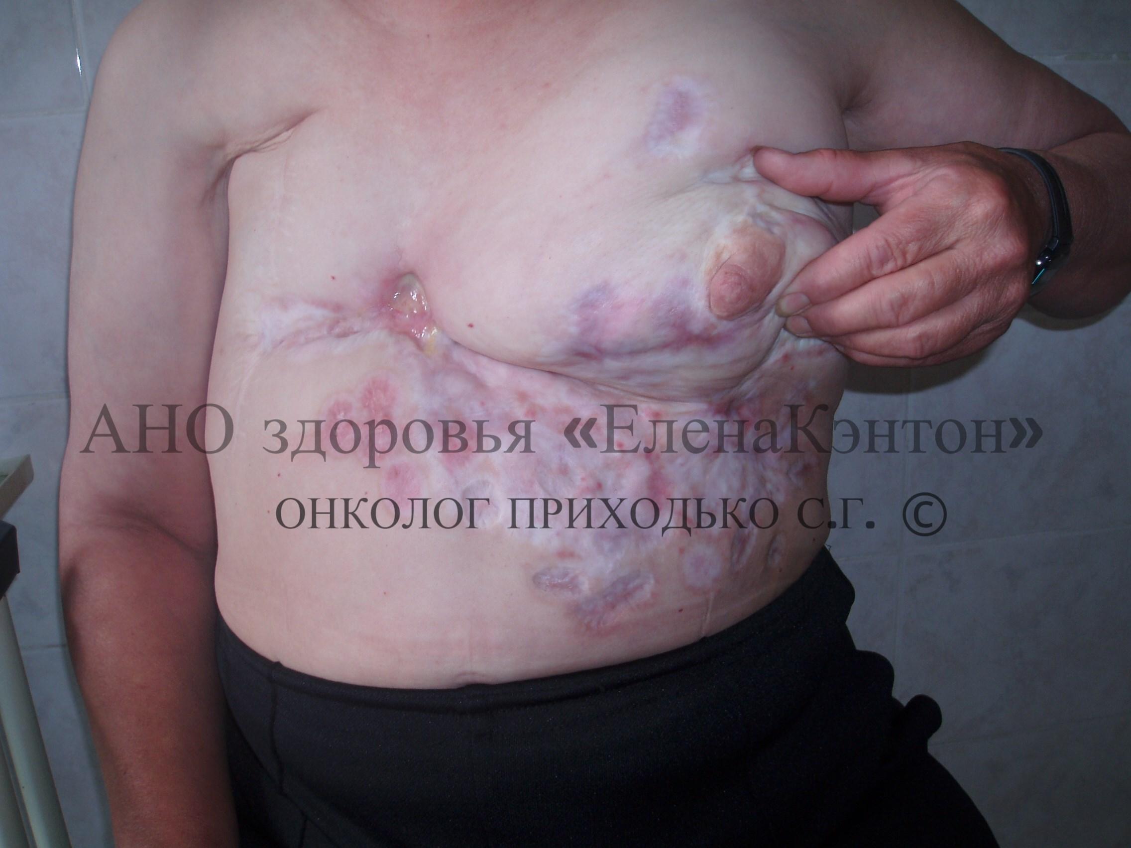 Базалиома на лице