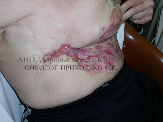 Базалиома лица