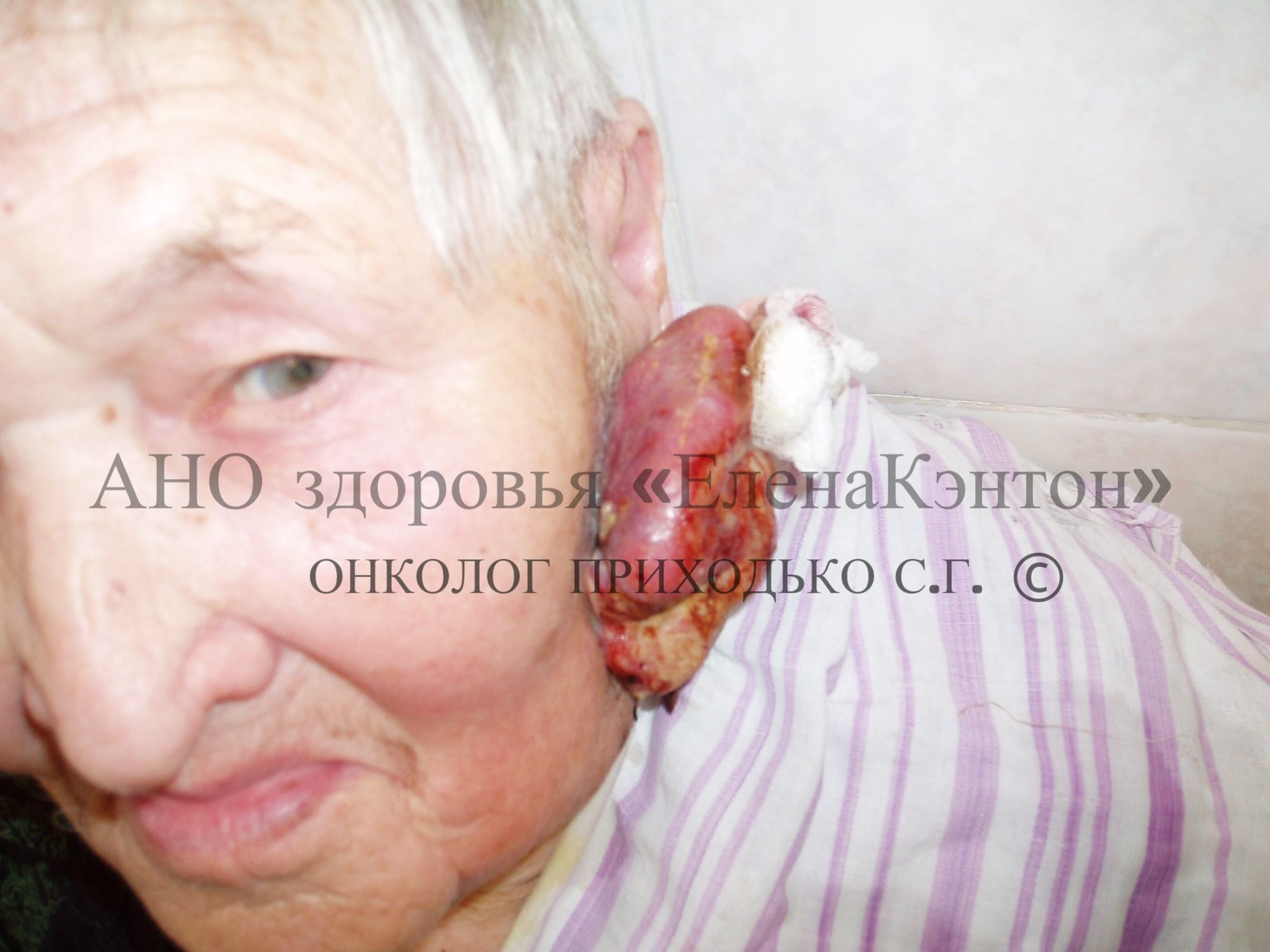 Базалиома лица