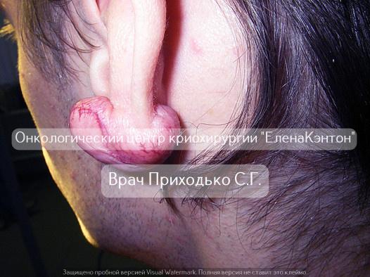 Базалиома лица