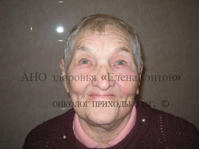 Базалиома на лице