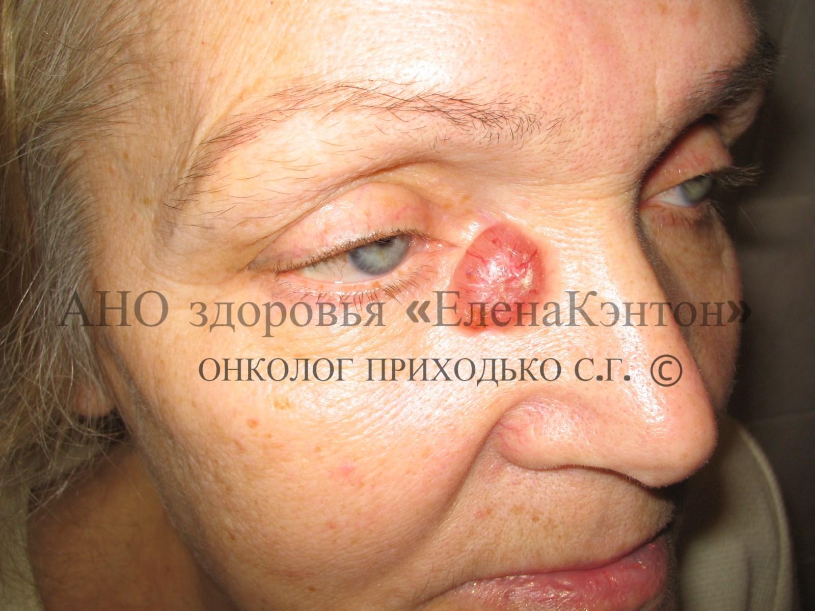 Базалиома на лице