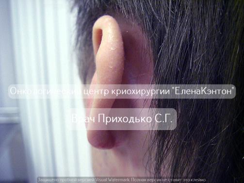 Базалиома на лице