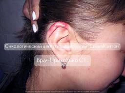 Базалиома на лице