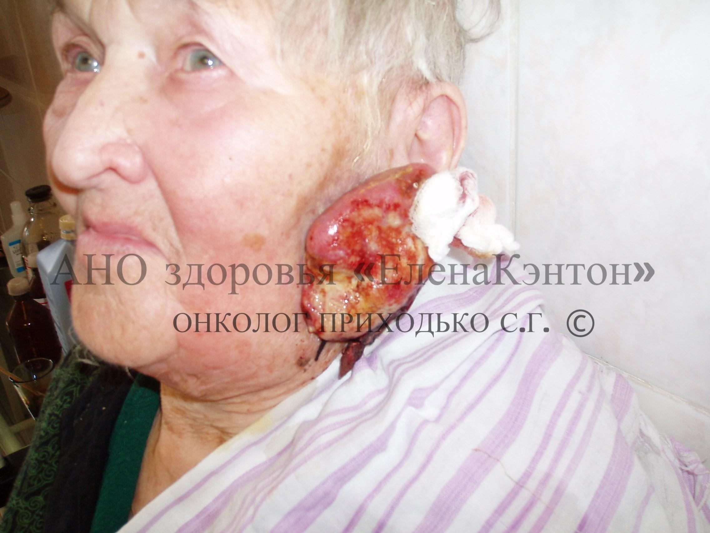 Базалиома лица