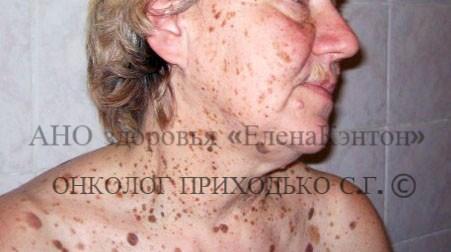 Базалиома лица