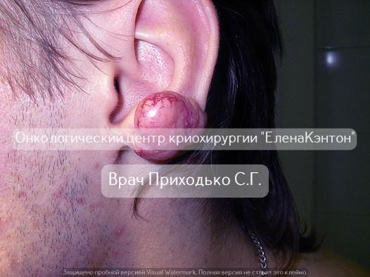 Базалиома лица