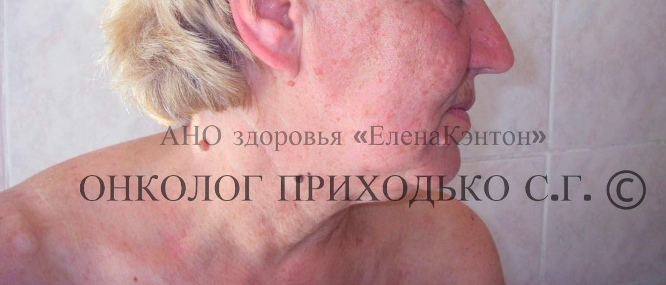 Базалиома на лице