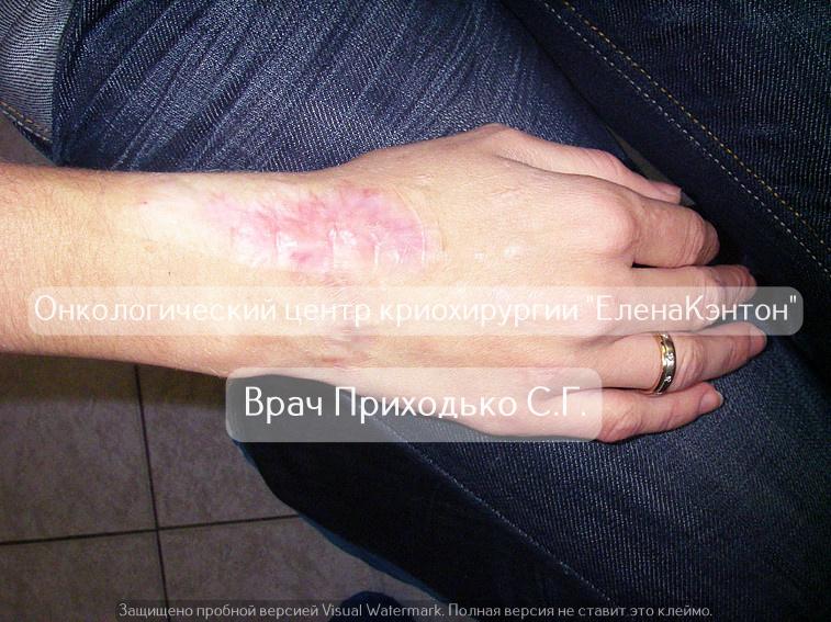 Базалиома на лице