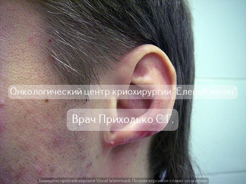 Базалиома на лице